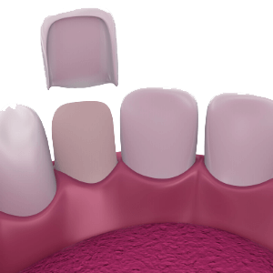 Porcelain Veneers