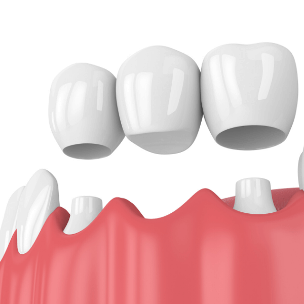 Dental Crown & Dental Bridges Melbourne 0002 (1)