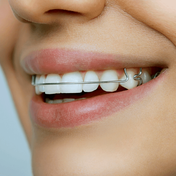Orthodontics Melbourne - retainer (1)