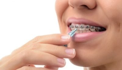 Oral Care During Orthodontic Treatment