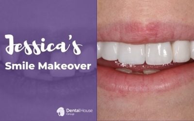 Jessica’s Dental Implant and Porcelain Crowns in Sunbury
