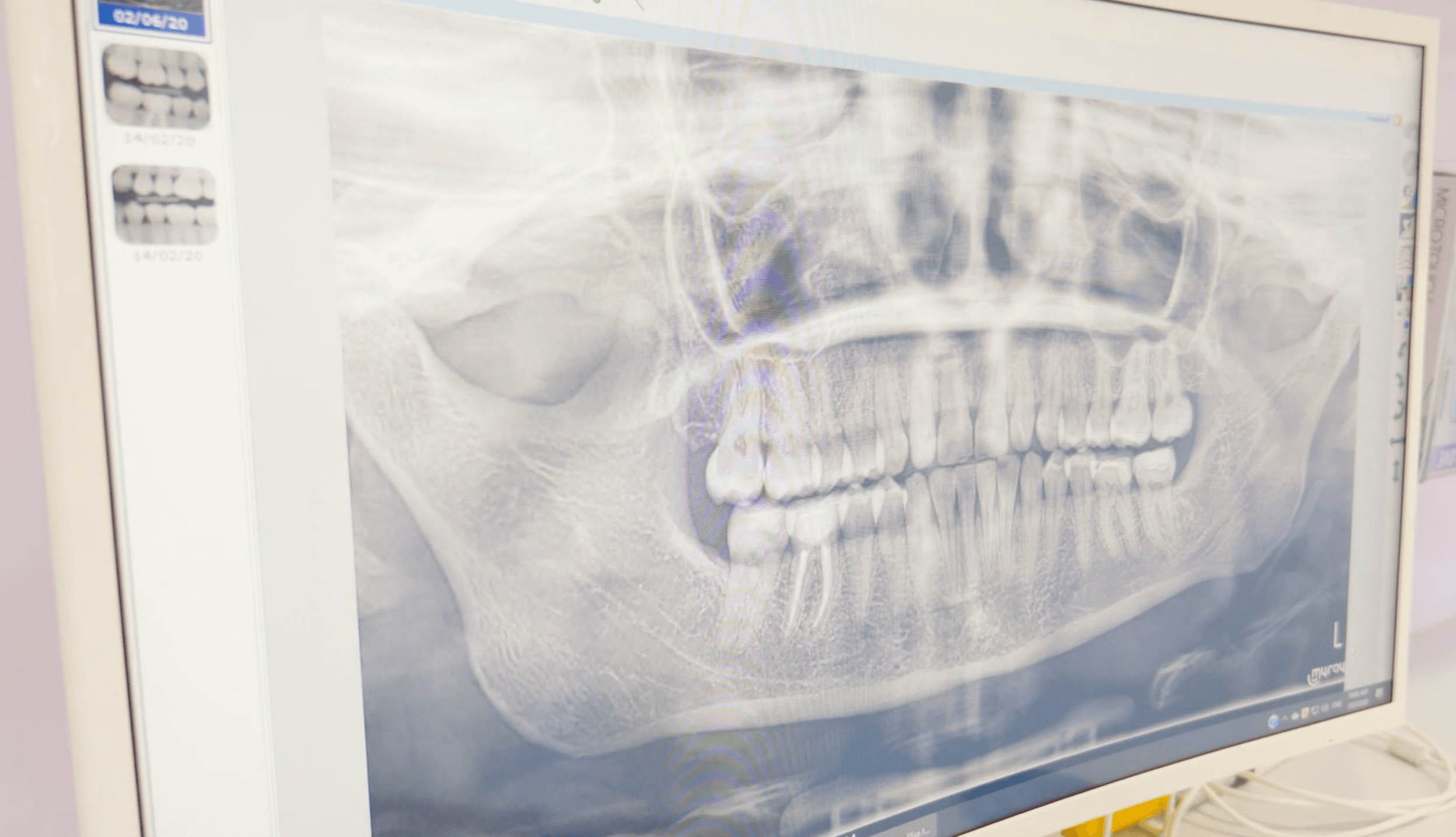 What Is The Cost Of Dental Implant? Dental House Group Dental Implant