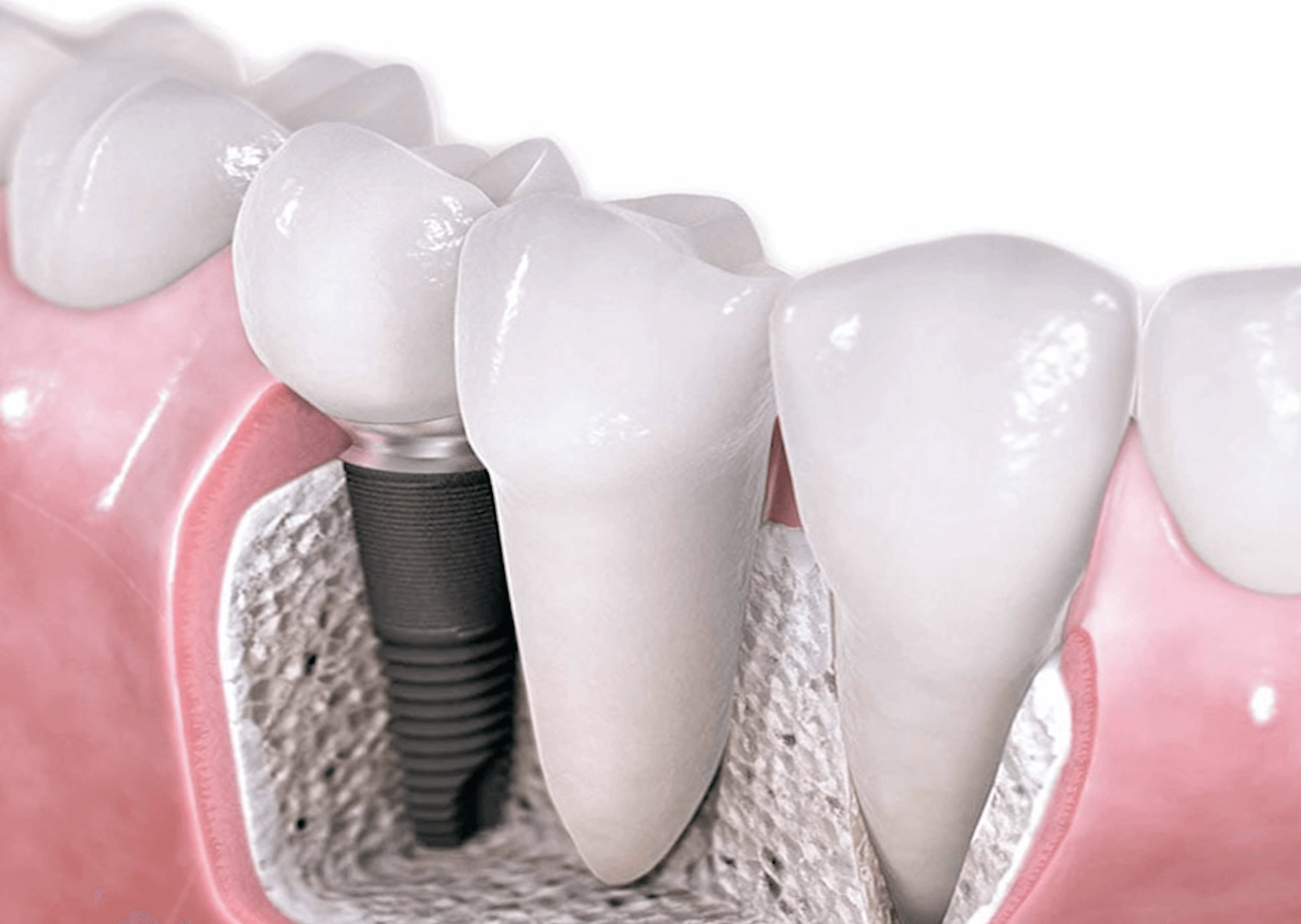 What Is The Cost Of Dental Implant? Dental Implant Components