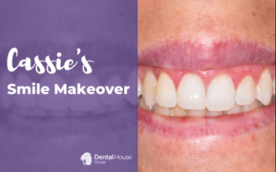 Cassie’s Smile Makeover in Sunbury