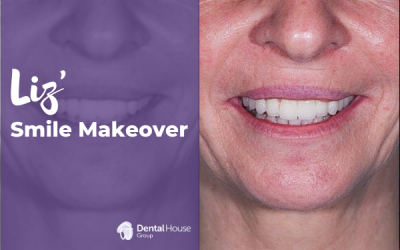 Liz’ Smile Makeover in Sunbury