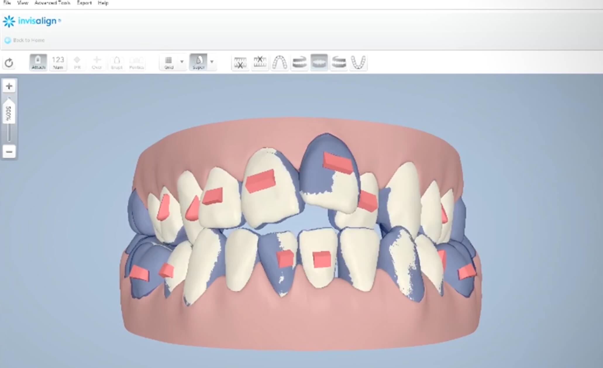 What Is The Cost Of Orthodontic Treatment? Aligners