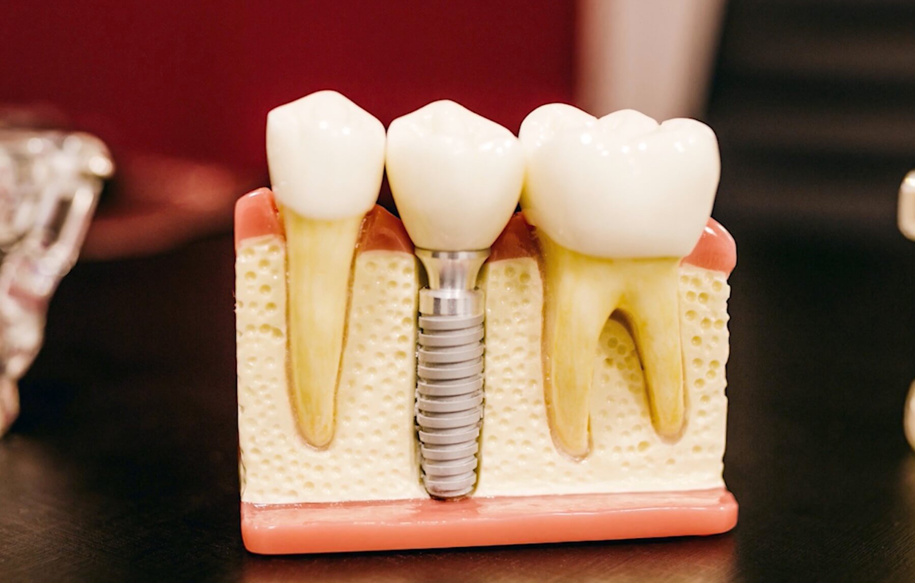 What Is The Process Of Dental Implant? Implant Melbourne Dental House Group