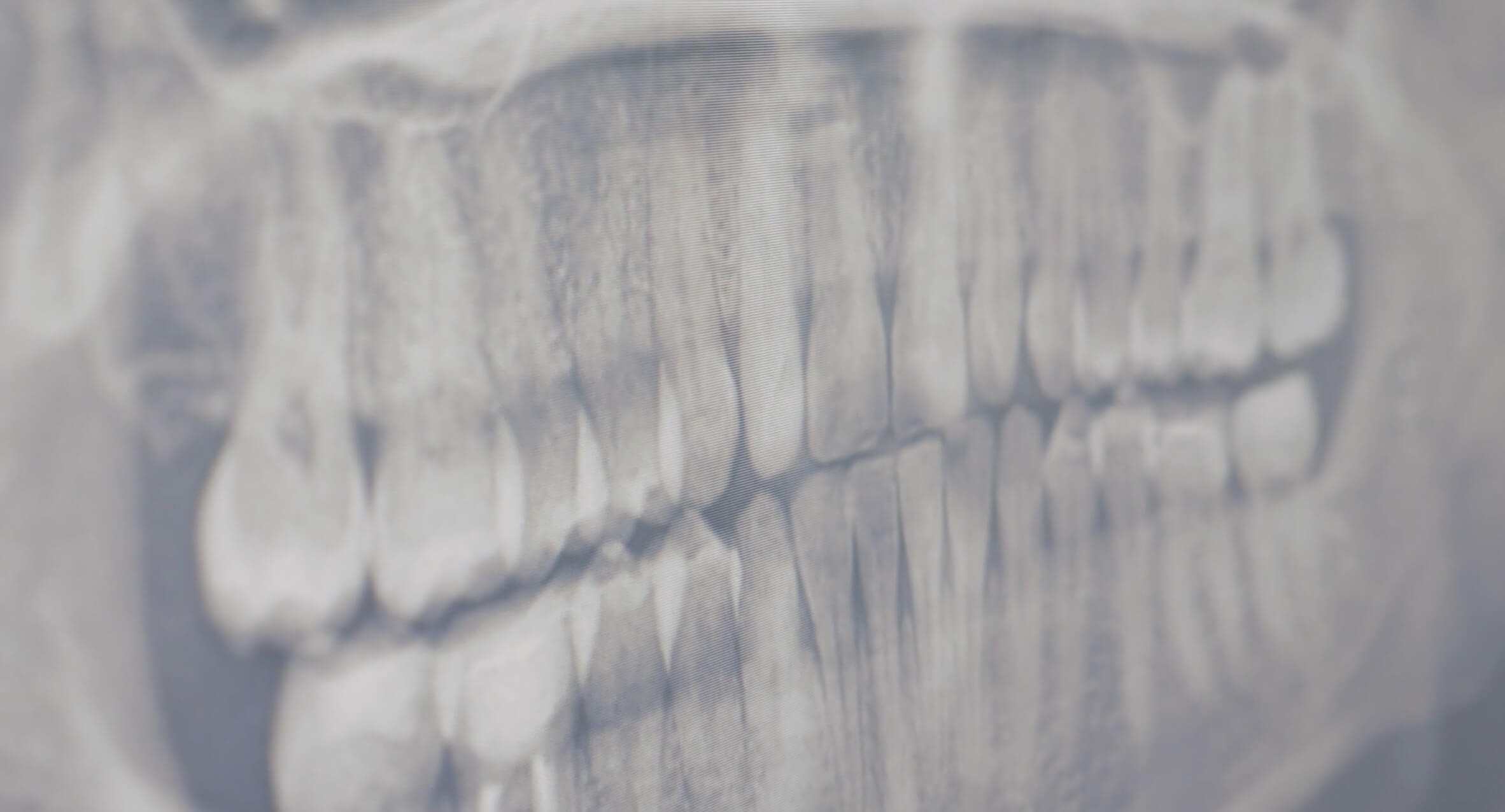 Wisdom Tooth Melbourne