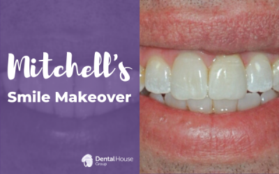 Mitchell’s Porcelain Crown Journey in Sunbury