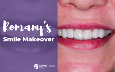 Romany’s Composite Veneers Journey in Sunbury