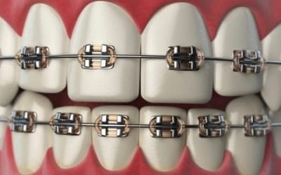 Straight Talk About Braces for Adults