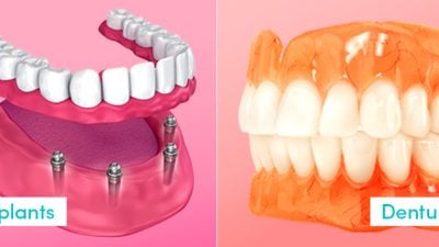 Dentures Vs. Dental Implants