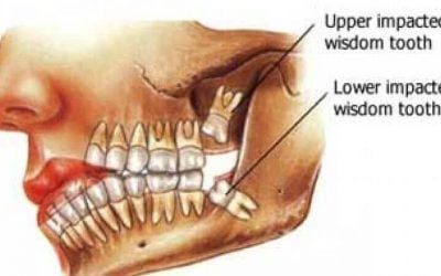 How Many Wisdom Teeth Do People Have
