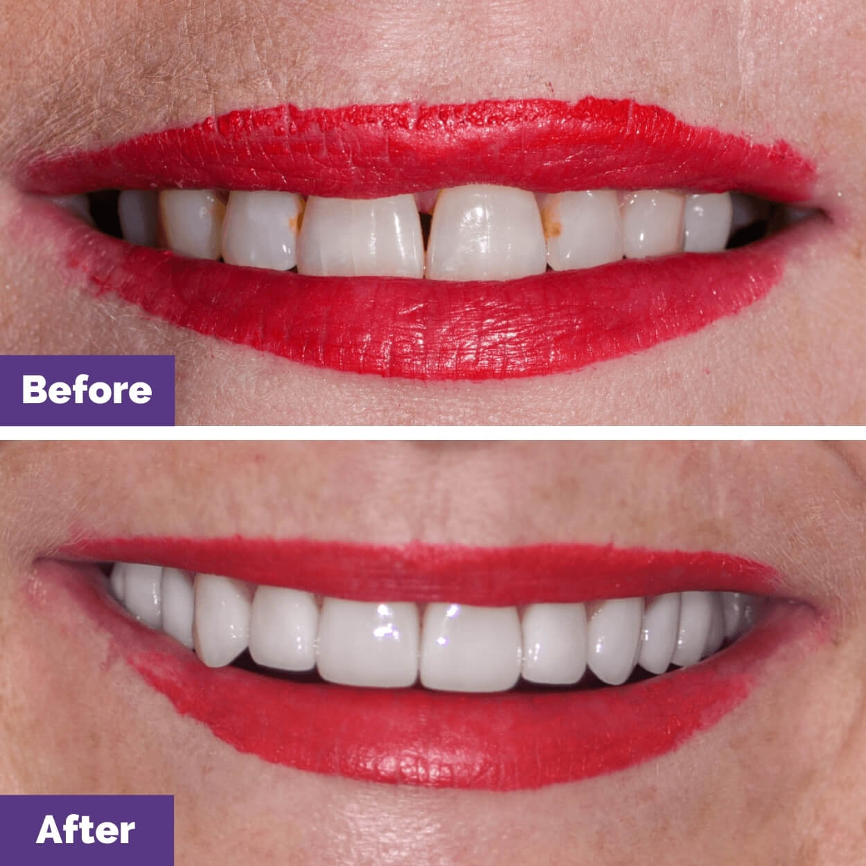 Cynthia’s Dental Implants and Porcelain Veneers Journey in Diggers Rest Dental House