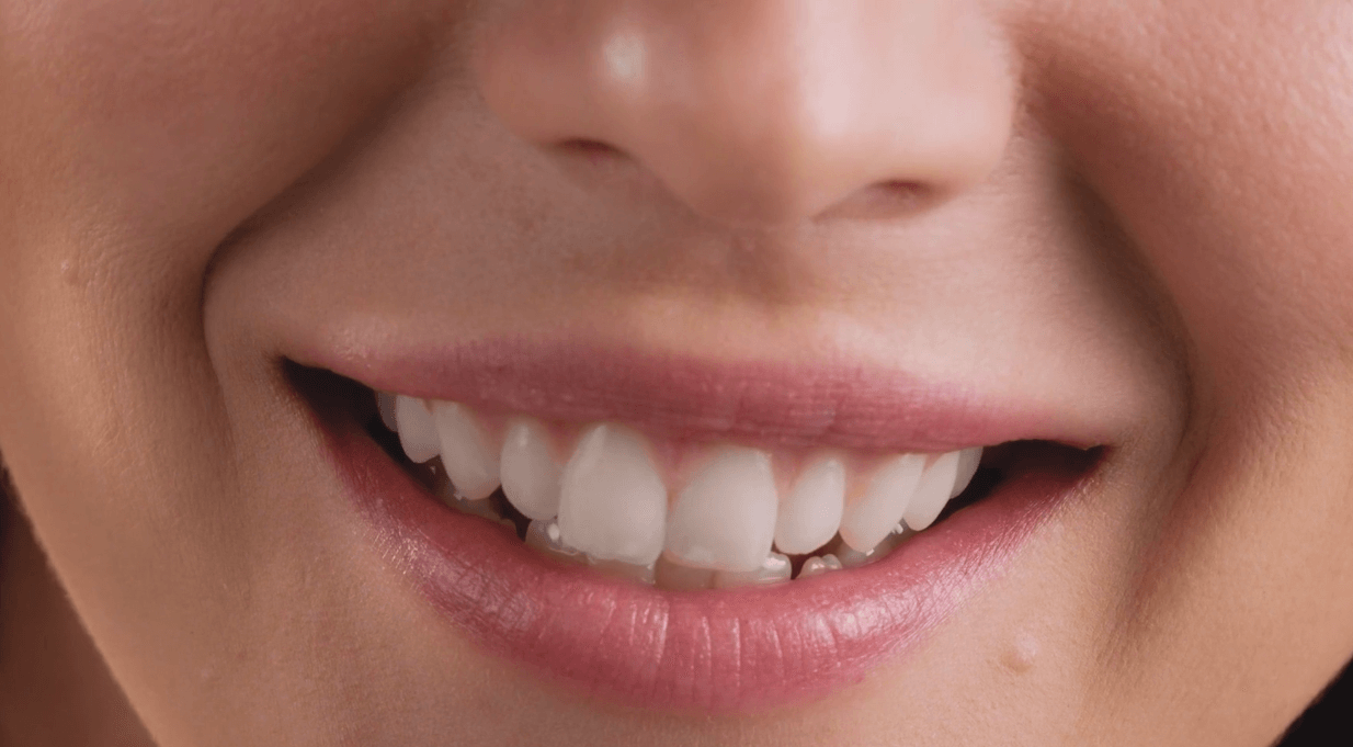 How Many Dental Veneers Should I Get
