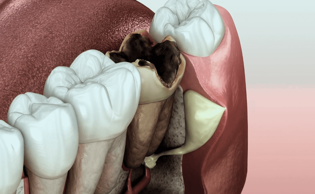 What Happens if I Ignore My Toothache