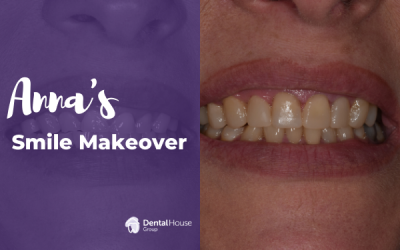 Anna’s Composite Veneers Journey in Gisborne