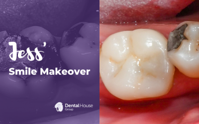 Jess’ Same-day Porcelain Crown Journey in Melbourne