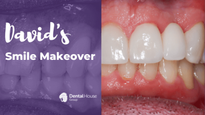 David’s Porcelain Crown & Veneers Journey in Sunbury