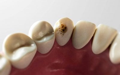 Can You Stop a Cavity Getting Worse?