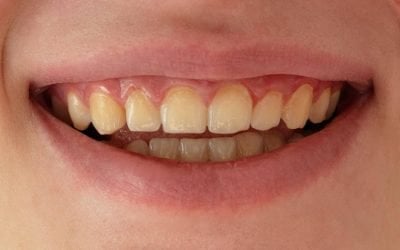 Chalky Teeth: Is the Writing on the Wall?