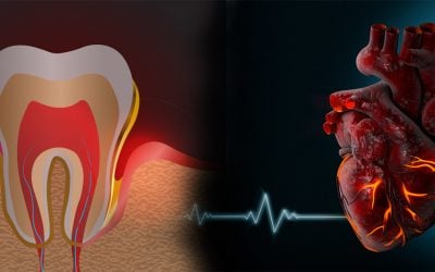 Tooth Decay, Cavities & Periodontal Disease: Do They Cause Heart Disease?