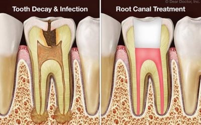 Endodontics: Can Tooth Pulp Be Made Healthier?