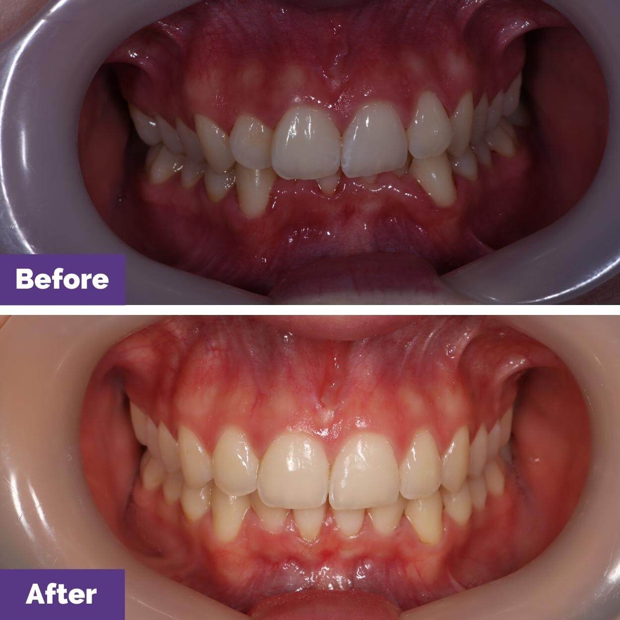 Eden's Smile Makeover Journey In Diggers Rest Dental House