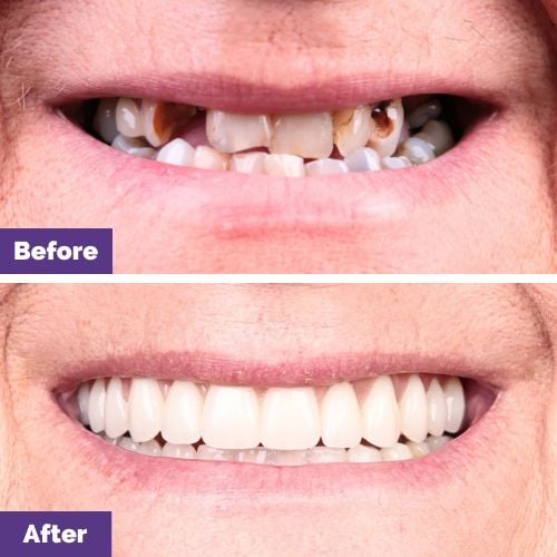 Carmen of Sunbury's All-On-4 Plus® Smile Makeover In Dental House