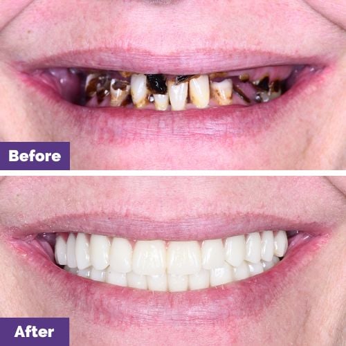 Danielle of Melton's All-On-4 Plus® Smile Makeover In Dental House