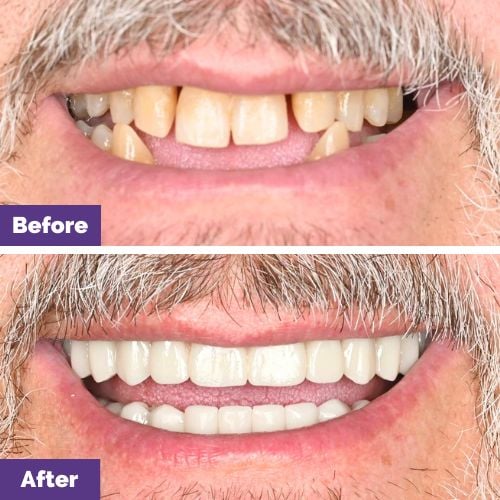 David of Sunbury's All-On-4 Plus® Smile Makeover In Dental House