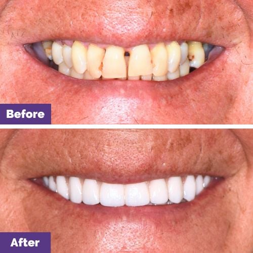 Dianne of Bacchus Marsh's All-On-4 Plus® Smile Makeover In Dental House