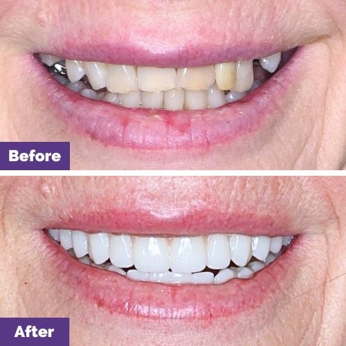 Kerry of Melton's All-On-4 Plus® Smile Makeover In Dental House