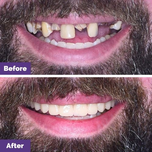 Matthew of Melton's All-On-4 Plus® Smile Makeover In Dental House