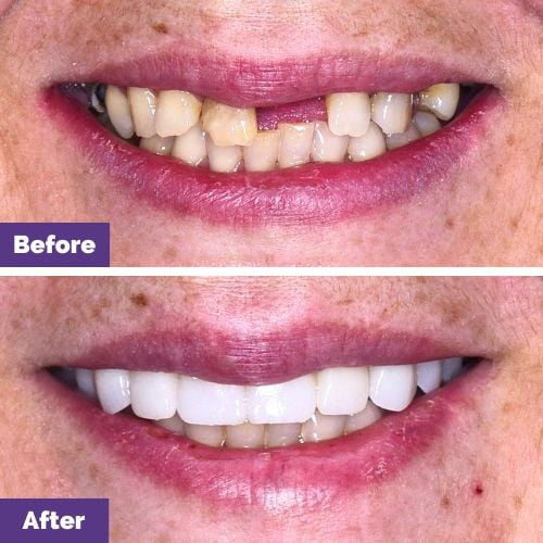 Rebecca of Melton's Crowns & Bridges Smile Makeover In Dental House