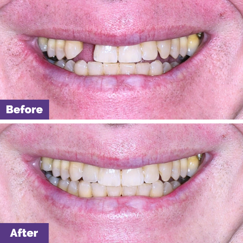 Jasper's Maryland Bridge Smile Makeover in Dental House