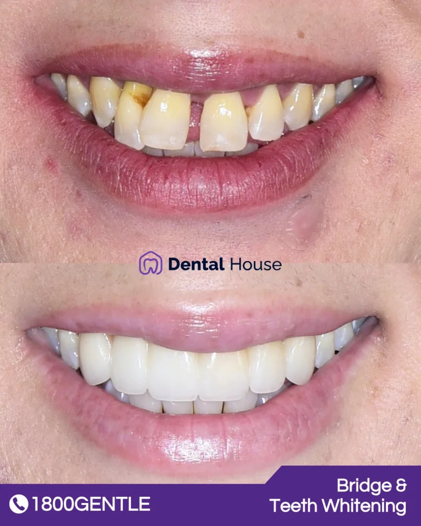 Bridge & Teeth Whitening