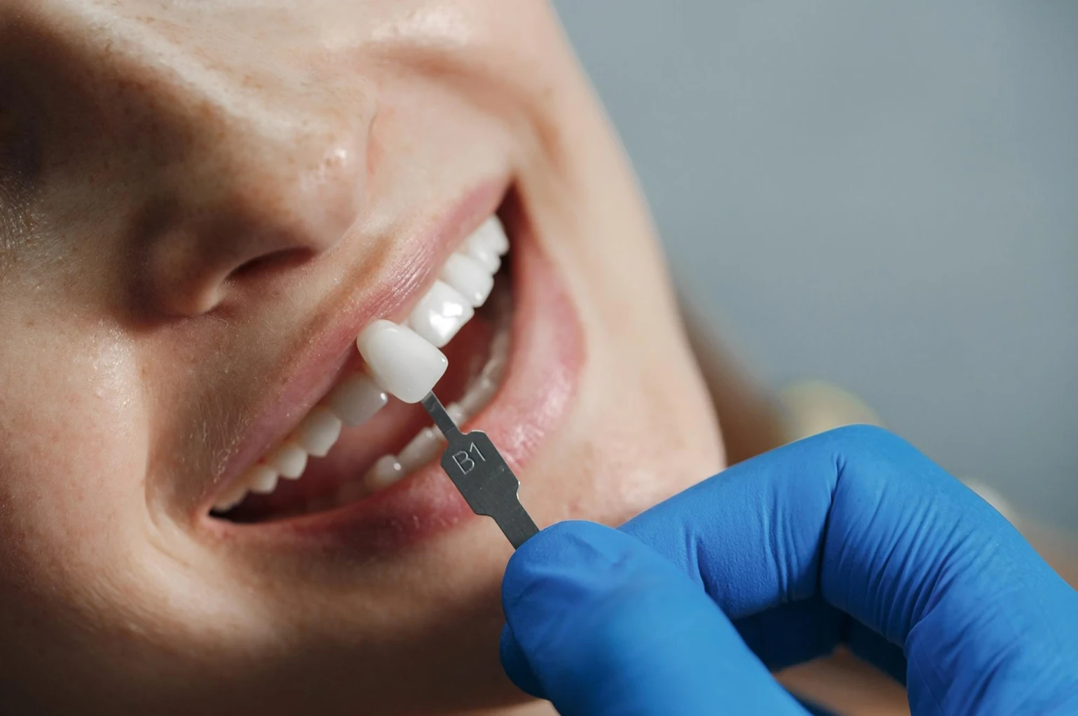 Composite Tooth Bonding
