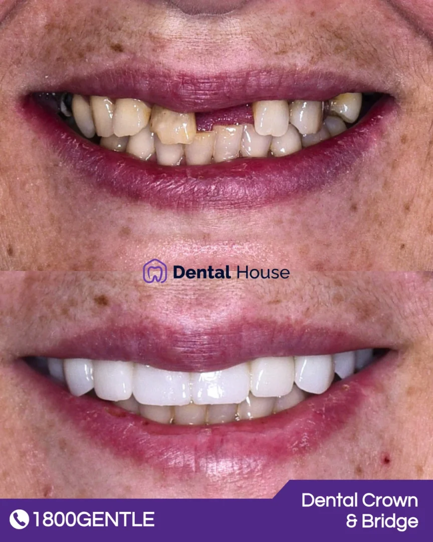 Dental Crown & Bridge