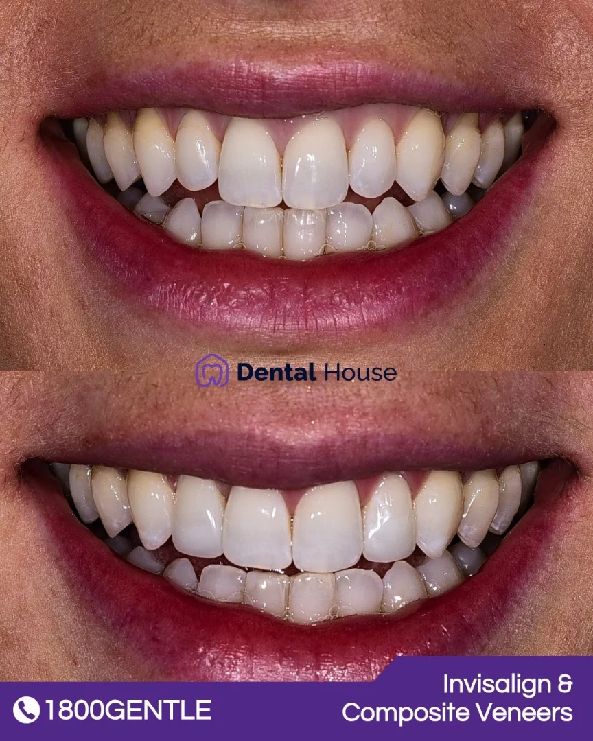 Invisalign & Composite Veneers
