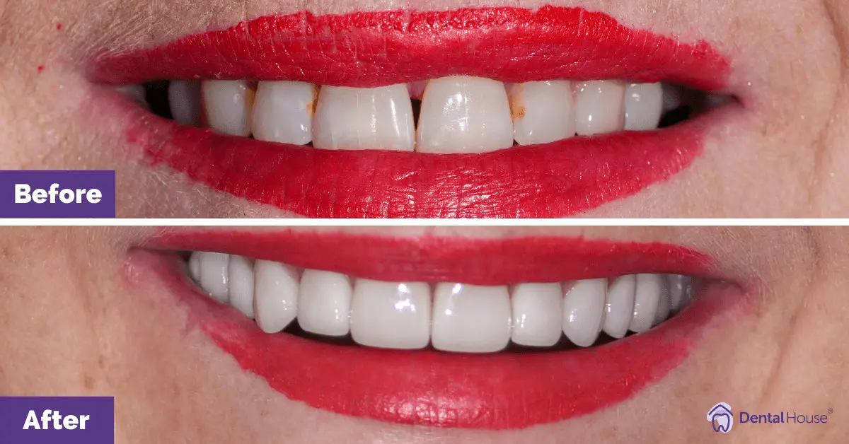 Dental Implant and Porcelain Veneers in Sunbury #3