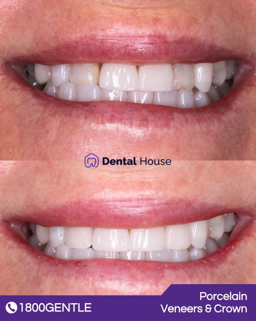 Porcelain Veneers & Crown