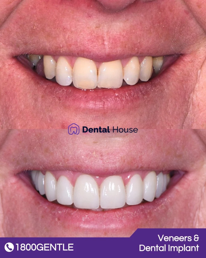 Porcelain Veneers