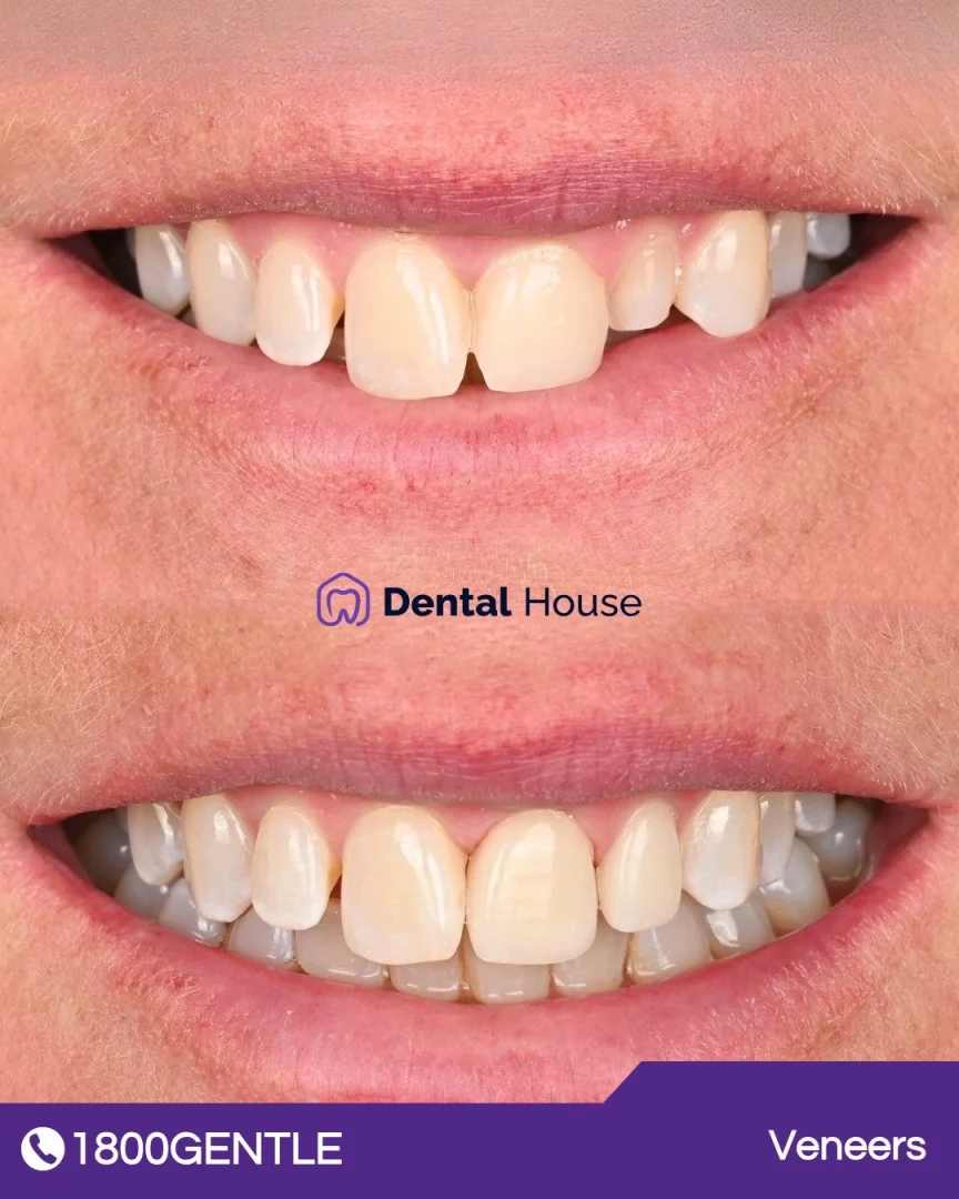 Porcelain Veneers