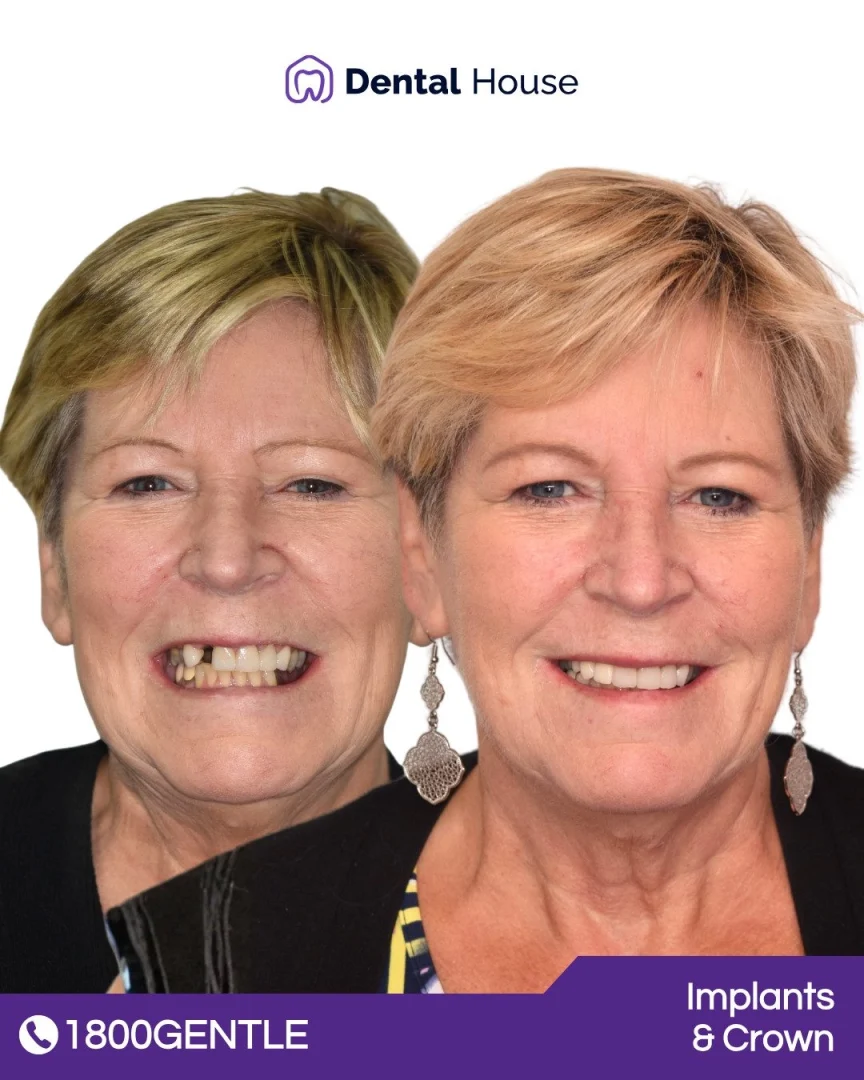 Dental Implants and Crown