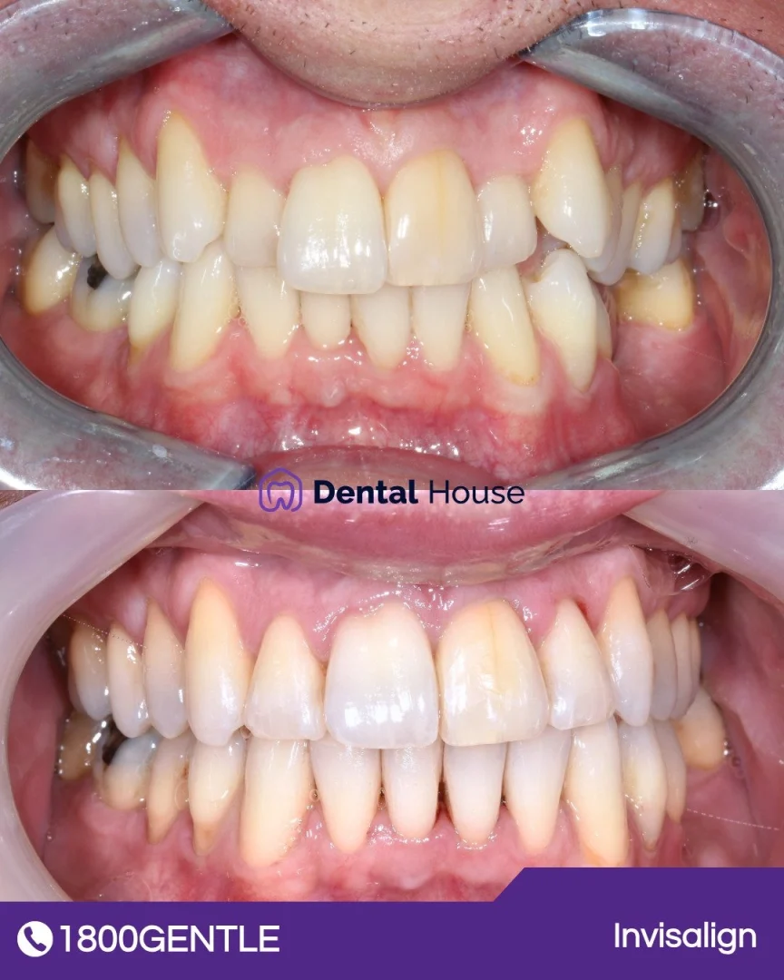 Invisalign