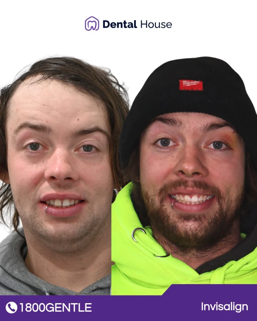 Treatment: Invisalign