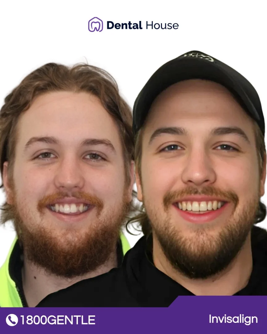 Invisalign