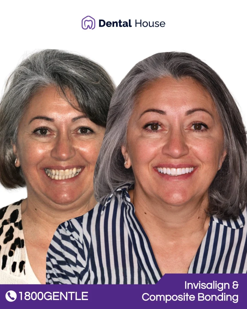 Invisalign & Composite Bonding