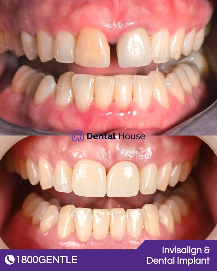 Invisalign & Dental Implant